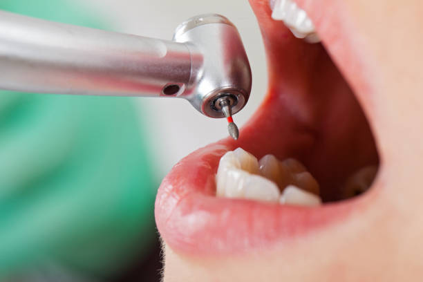 Best Knocked-Out Tooth (Avulsed Tooth) Treatment in Albany, CA